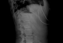 “손이 자꾸 저려요”… 거북목보다 위험한 ‘흉곽출구증후군’ A black and white photo of a man's back